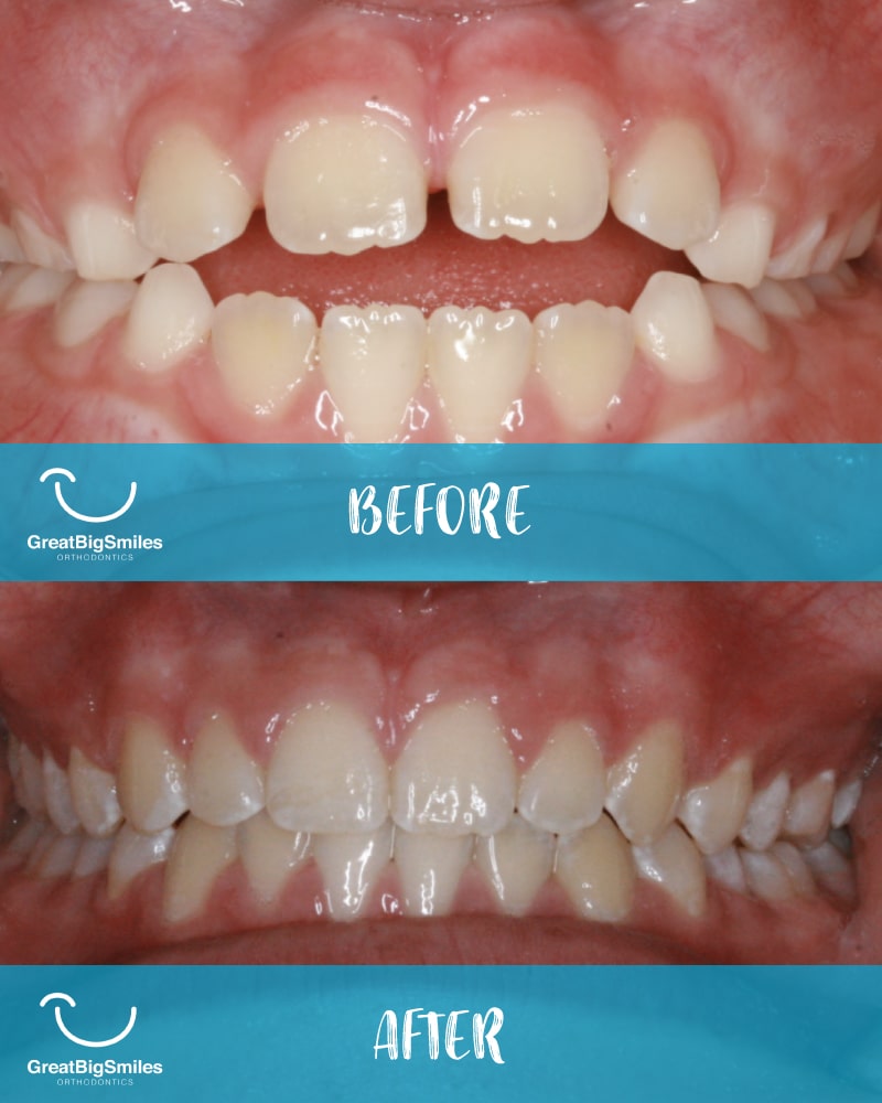 Before and after shot of orthodontic treatment