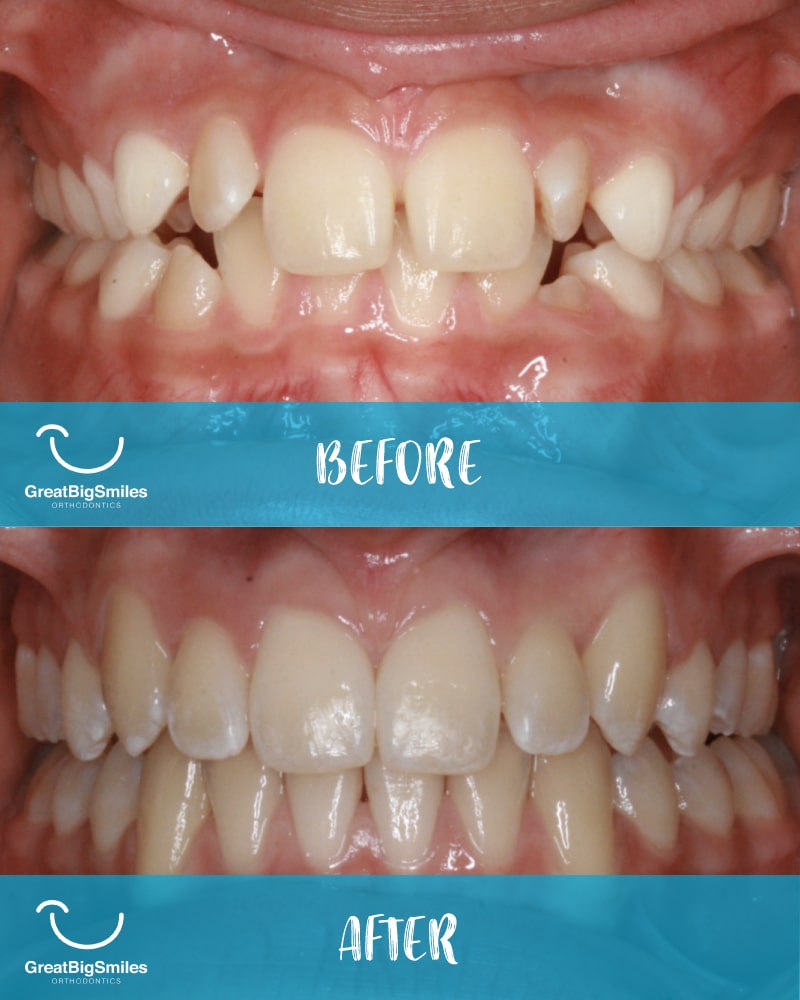 Before and after shot of orthodontic treatment