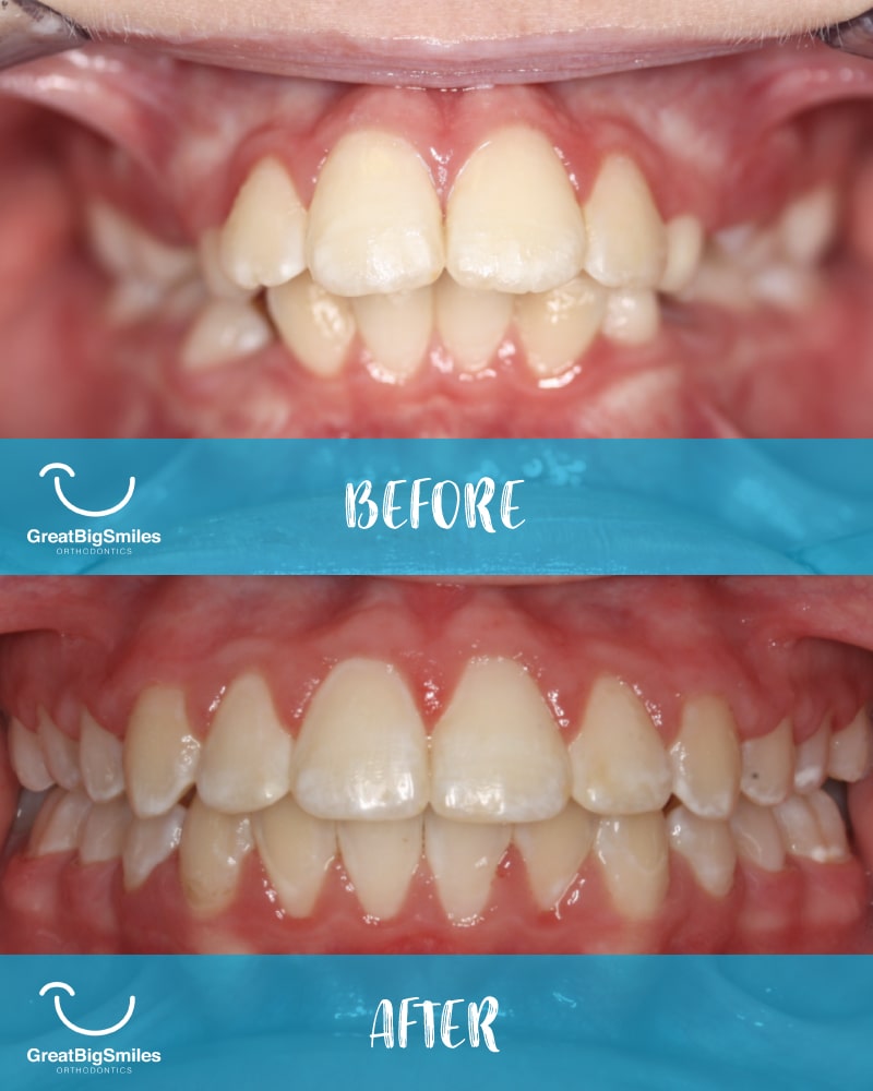 Before and after shot of orthodontic treatment